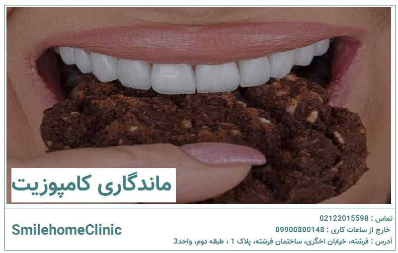 ماندگاری کامپوزیت دندان چقدر است؟