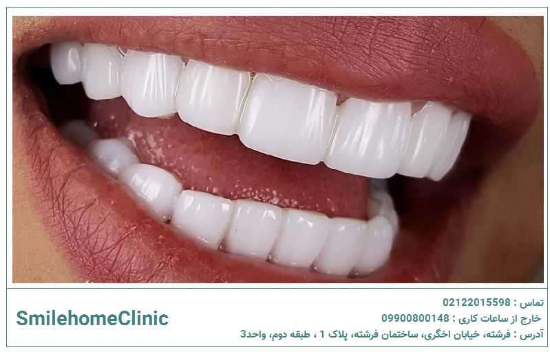 کامپوزیت چیست