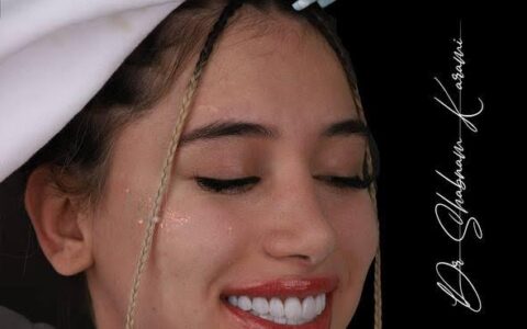 لمینت و کامپوزیت توسط دکتر شبنم کریمی دندانپزشک زیبایی