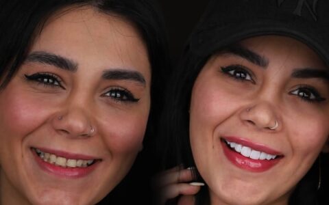 لمینت و کامپوزیت توسط دکتر شبنم کریمی دندانپزشک زیبایی