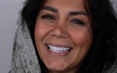 لمینت و کامپوزیت توسط دکتر شبنم کریمی دندانپزشک زیبایی