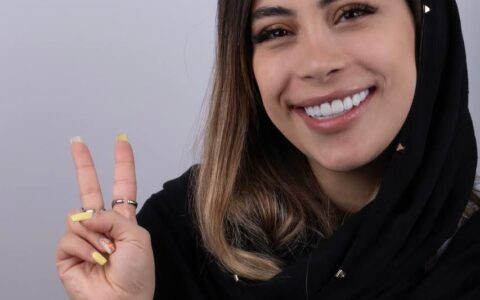 لمینت و کامپوزیت توسط دکتر شبنم کریمی دندانپزشک زیبایی