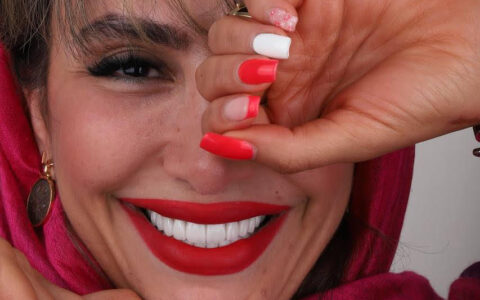 لمینت و کامپوزیت توسط دکتر شبنم کریمی دندانپزشک زیبایی