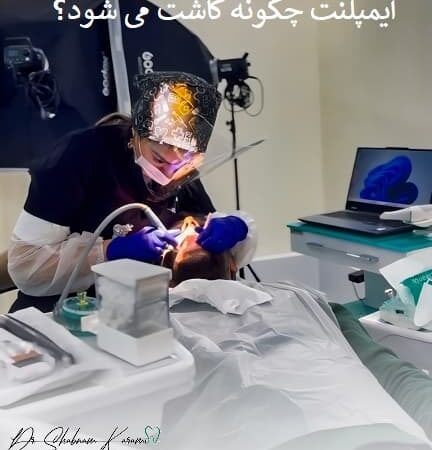 ایمپلنت چگونه کاشت می شود؟