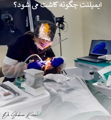 ایمپلنت چگونه کاشت می شود؟