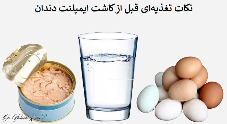 نکات تغذیه‌ای قبل از کاشت ایمپلنت دندان