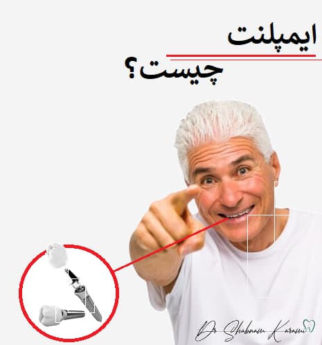 ایمپلنت چیست؟