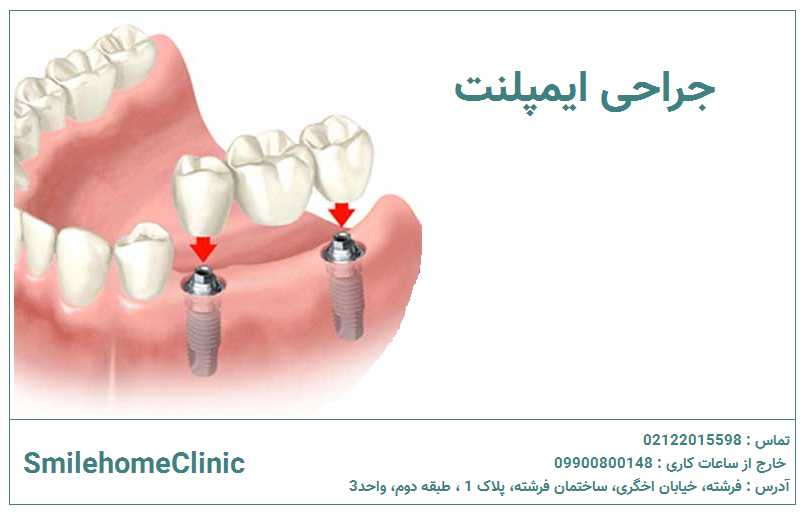 جراحی ایمپلنت