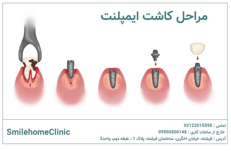 مراحل ایمپلنت ایمپلنت چگونه کاشت می شود