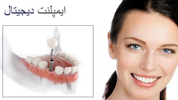 مزایای استفاده از ایمپلنت دیجیتال چیست؟