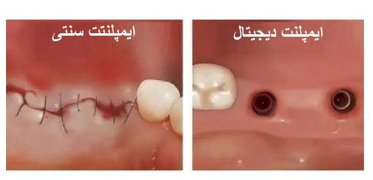 ایمپلنت دیجیتال چه تفاوتی با ایمپلنت سنتی دارد؟