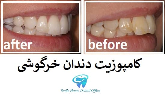 کامپوزیت دندان خرگوشی