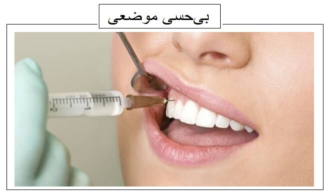 بی حسی برای ایمپلنت یکی از راهکار های درمان درد ایمپلنت