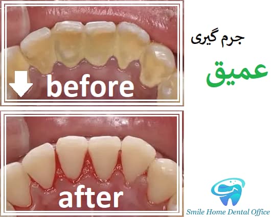 جرم گیری عمیق دندان