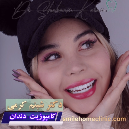 کامپوزیت دندان در کلینیک اسمایل هوم کلینیک شمال تهران