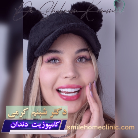 کامپوزیت دندان برای سفیدی و خنده هالیودی