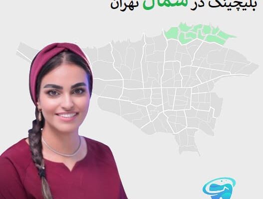 بلیچینگ در شمال تهران