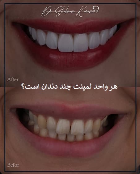 هر واحد لمینت چند دندان است؟