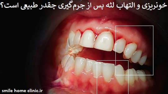 خونریزی و التهاب لثه پس از جرم‌گیری چقدر طبیعی است؟