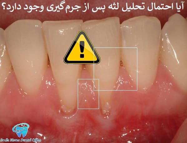 آیا احتمال تحلیل لثه پس از جرم‌گیری وجود دارد؟