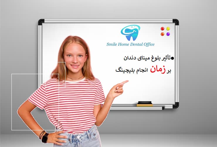تأثیر بلوغ مینای دندان بر زمان انجام بلیچینگ