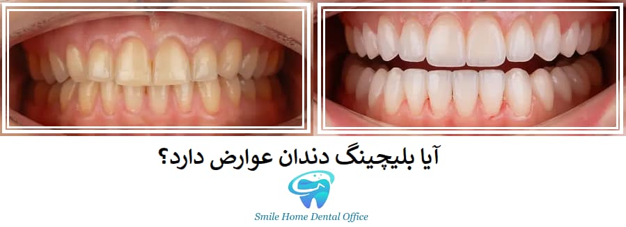 آیا بلیچینگ دندان عوارض دارد؟