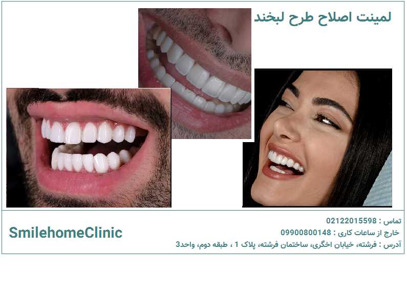لمینت طرح لبخند