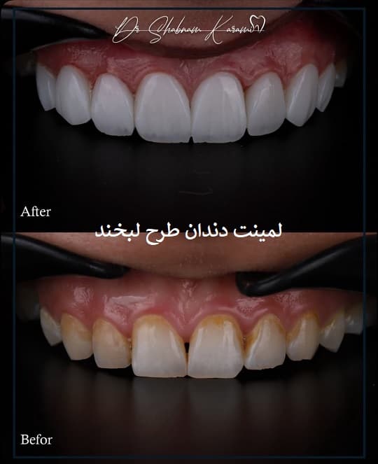 لمینت دندان طرح لبخند