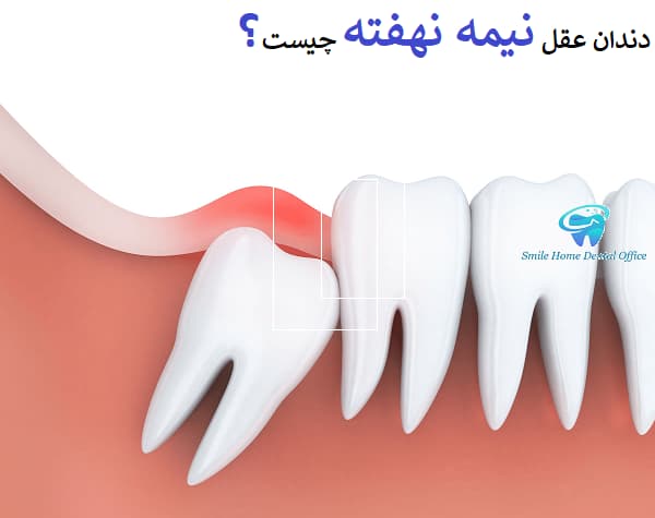  دندان عقل نیمه‌نهفته چیست