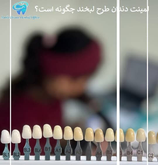 لمینت دندان طرح لبخند چگونه است؟