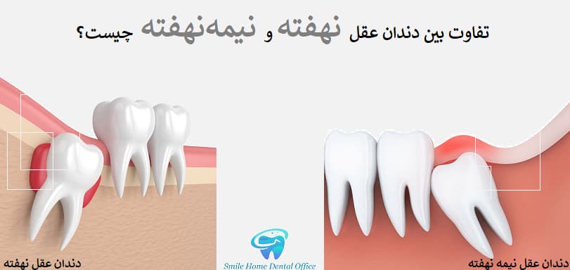  تفاوت بین دندان عقل نهفته و نیمه‌نهفته چیست؟
