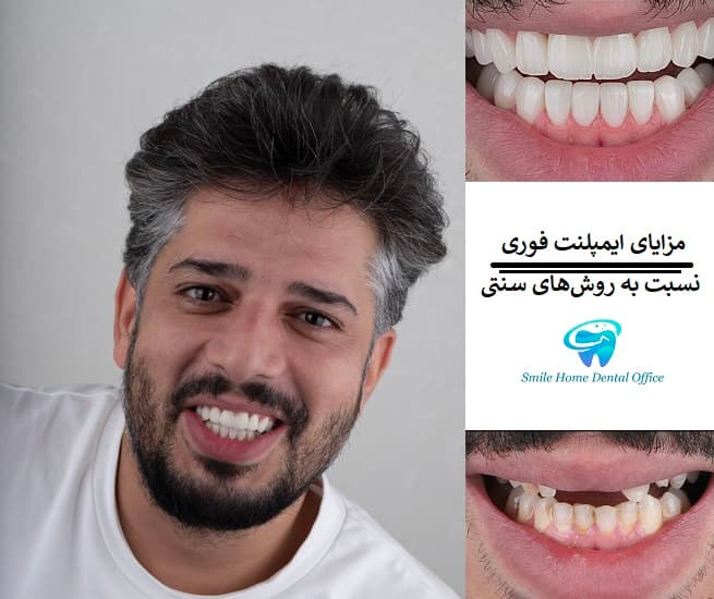 مزایای ایمپلنت فوری نسبت به روش‌های سنتی