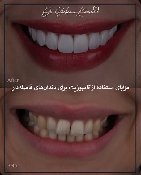 مزایای استفاده از کامپوزیت برای دندان‌های فاصله‌دار