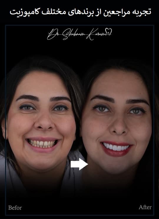 تجربه مراجعین از برندهای مختلف کامپوزیت