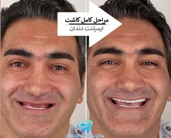 مراحل کامل کاشت ایمپلنت دندان