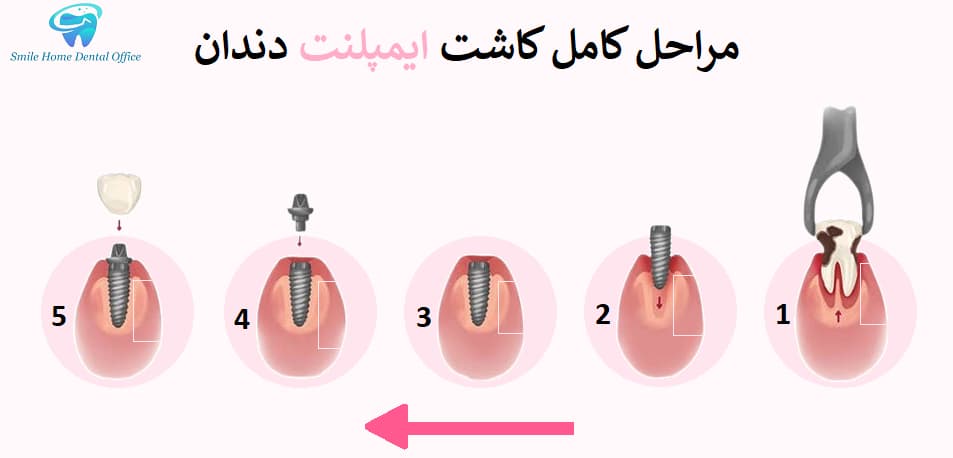 مراحل کامل کاشت ایمپلنت دندان