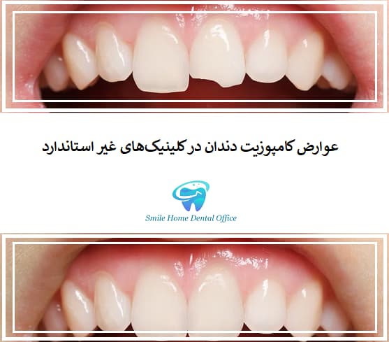 عوارض کامپوزیت دندان در کلینیک‌های غیر استاندارد