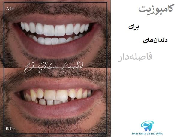 کامپوزیت برای دندان های فاصله دار