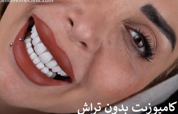 کامپوزیت بدون تراش