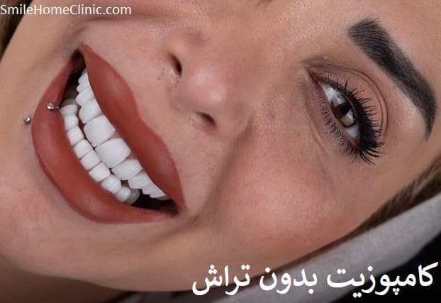 کامپوزیت بدون تراش