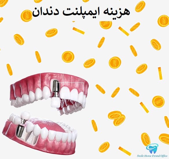 هزینه ایمپلنت دندان