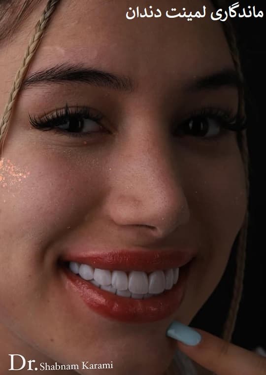 ماندگاری لمینت دندان