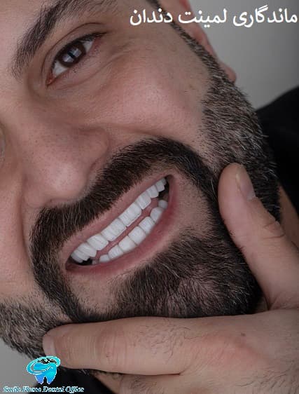 ماندگاری لمینت دندان