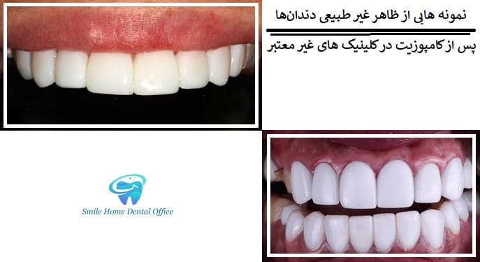 نمونه هایی از ظاهر غیر طبیعی دندان‌ها پس از کامپوزیت در کلینیک های غیر معتبر