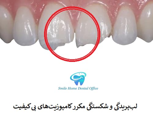 لب‌پریدگی و شکستگی مکرر کامپوزیت‌های بی‌کیفیت