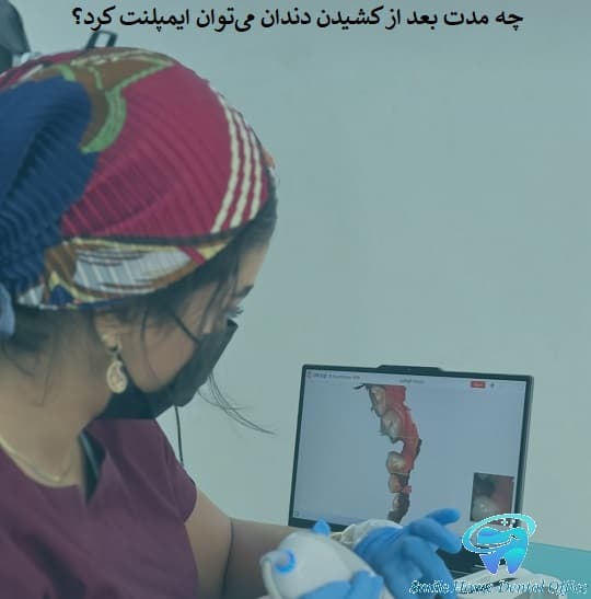 چه مدت بعد از کشیدن دندان می‌توانم ایمپلنت کنم؟