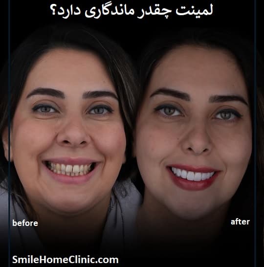 لمینت چقدر ماندگاری دارد؟ بررسی علمی و تجربی