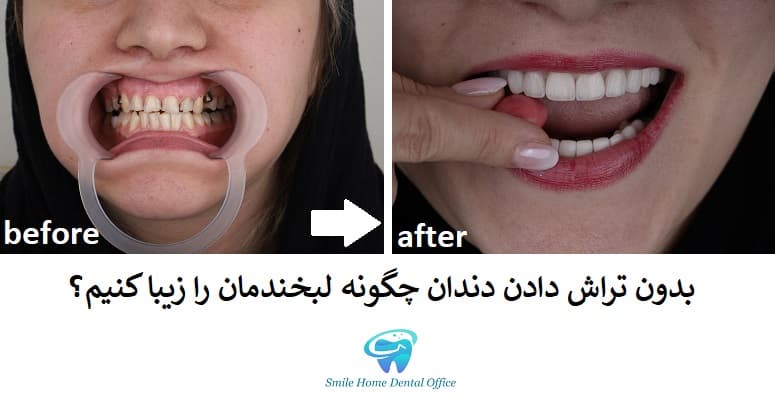 بدون تراش دادن دندان چگونه لبخندمان را زیبا کنیم؟