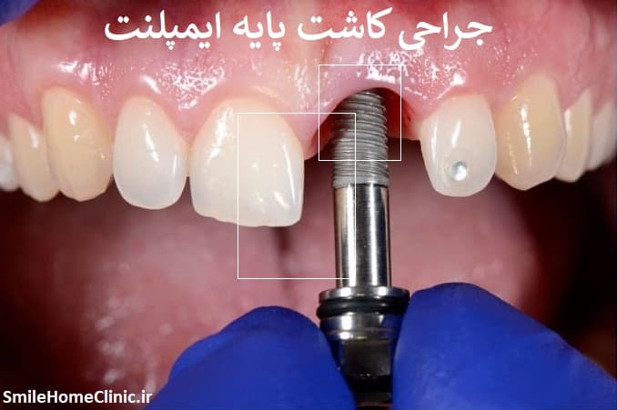 جراحی کاشت پایه ایمپلنت