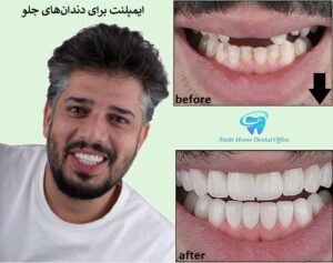 ایمپلنت برای دندانهای جلو
